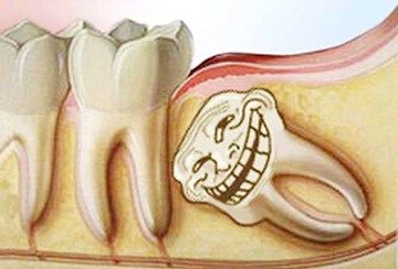 зуб мудрости неправильно растет