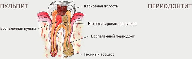 что такое периодонтит