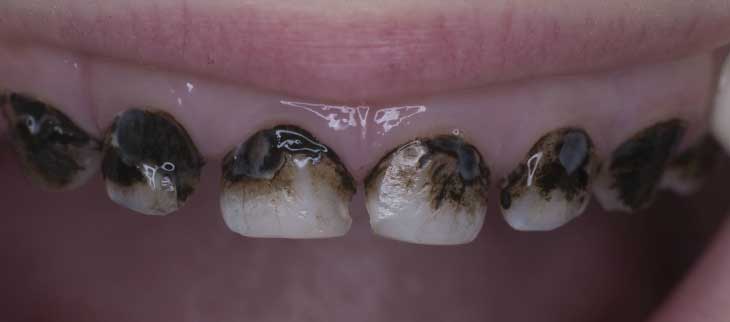 Насколько опасен черный налет на зубах и как его лечить?