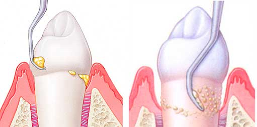 Подробное описание способов удаления зубного камня и рекомендации после процедур