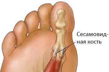 Сесамовидная кость большого пальца ноги