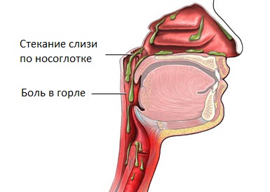 Постназальный синдром