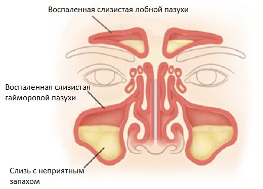 Образование слизи при синусите