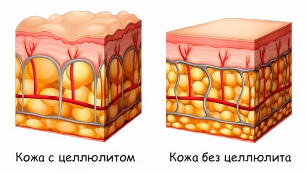 Сравнение кожи с целлюлитом и без