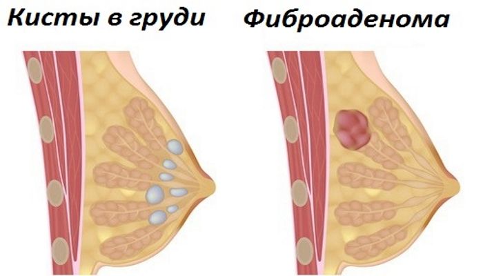 Киста и фиброаденома