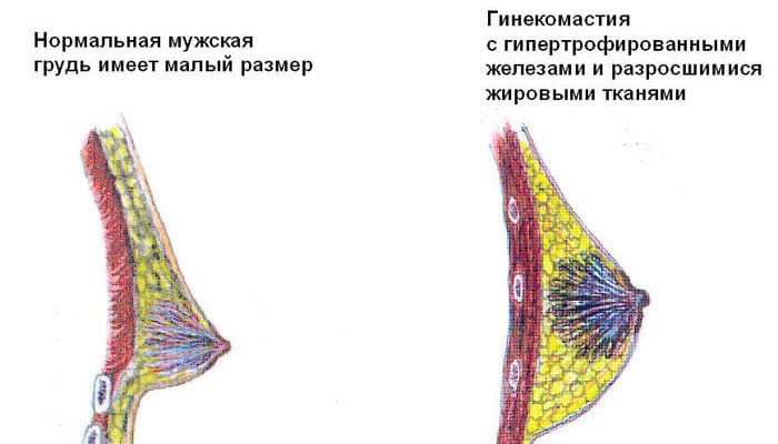 Виды гинекомастии