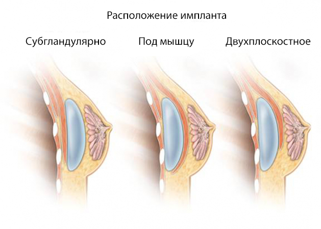 Расположение импланта