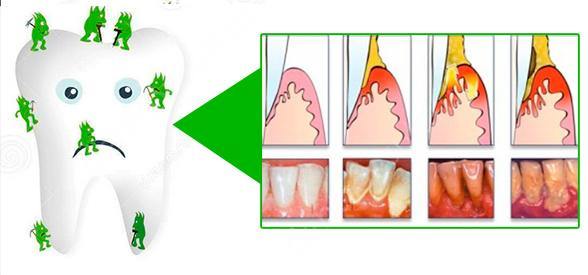 причины зубного камня