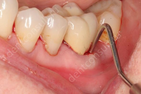 лечение флюса зуба