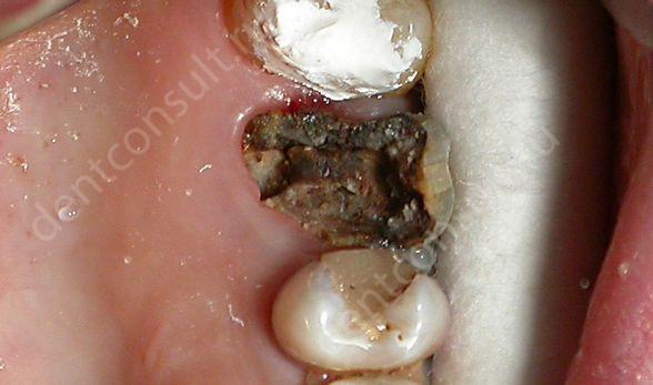 Фото: запущенный кариес, как причина возникновения флюса зуба 