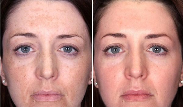 Отзывы на ультразвуковой пилинг лица с фото до и после