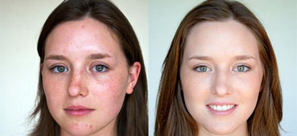 Отзывы на ультразвуковой пилинг лица с фото до и после