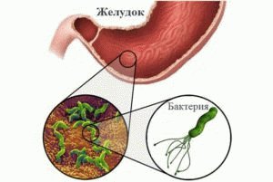 Гастрит желудка пациента