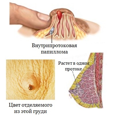 Внутрипротоковая папиллома молочной железы