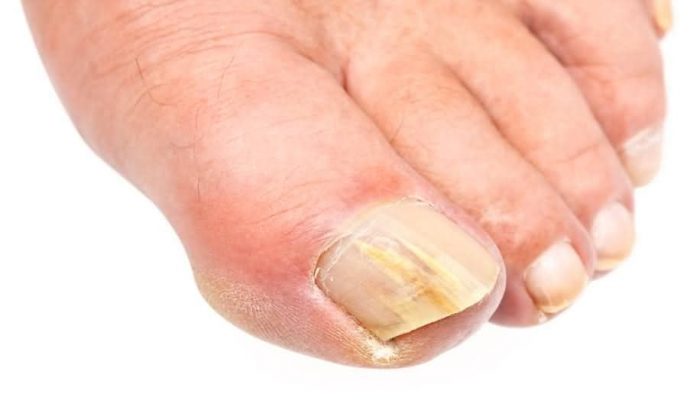 грибок ногтя большого пальца