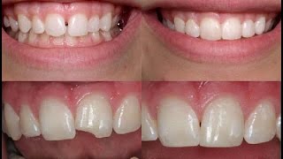 Реставрация скола зуба