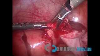 Киста яичника - лапароскопия, операция