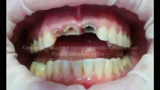 Dr-Azamat Tekuyev-Smile Designer-vkladki kultevie-koronki keramicheskie03