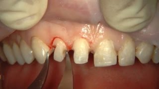 Реставрация зубов с помощью нанокомпозита CAPO (Schutz, Германия)