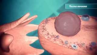 Хирургическое лечение кисты яичника