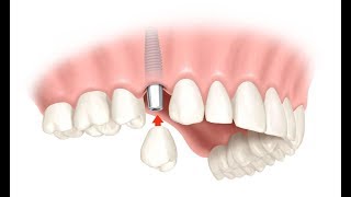 ИМПЛАНТАЦИЯ ЗУБОВ. Заключительный этап - УСТАНОВКА КОРОНКИ