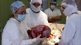 Гигантская кистома яичника (видео содержит хирургическую операцию)