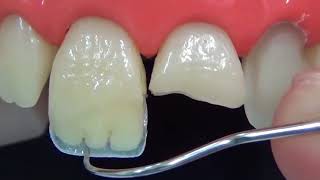 Прямая реставрация переднего зуба за 3 минуты (ускоренное видео). Восстановление переднего зуба