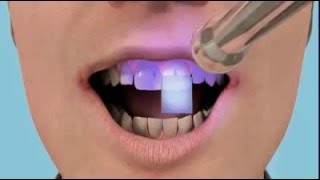 Наращивание зуба