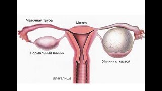 Удаление эндометриоидной кисты с максимальным сохранением ткани яичника