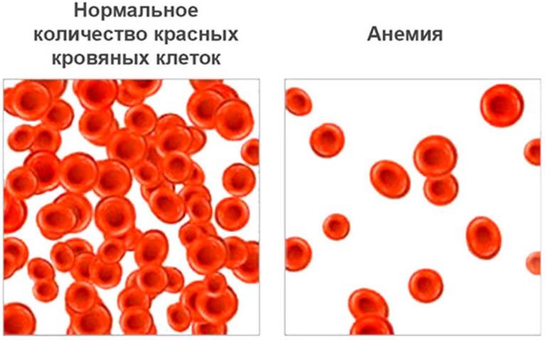 Анемия