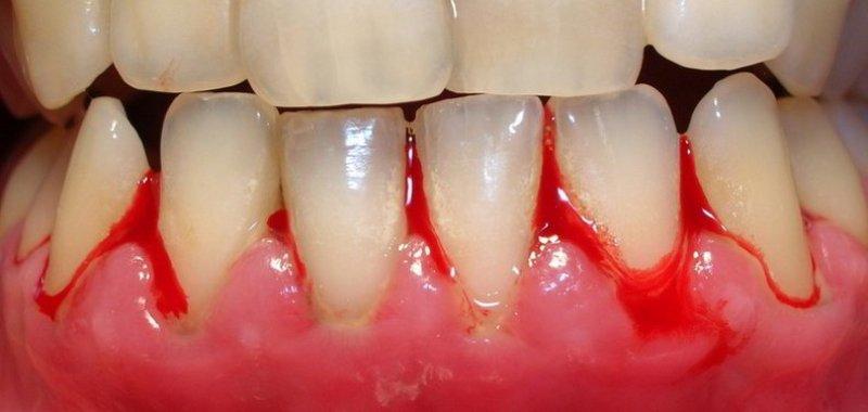 Болезнь зубов