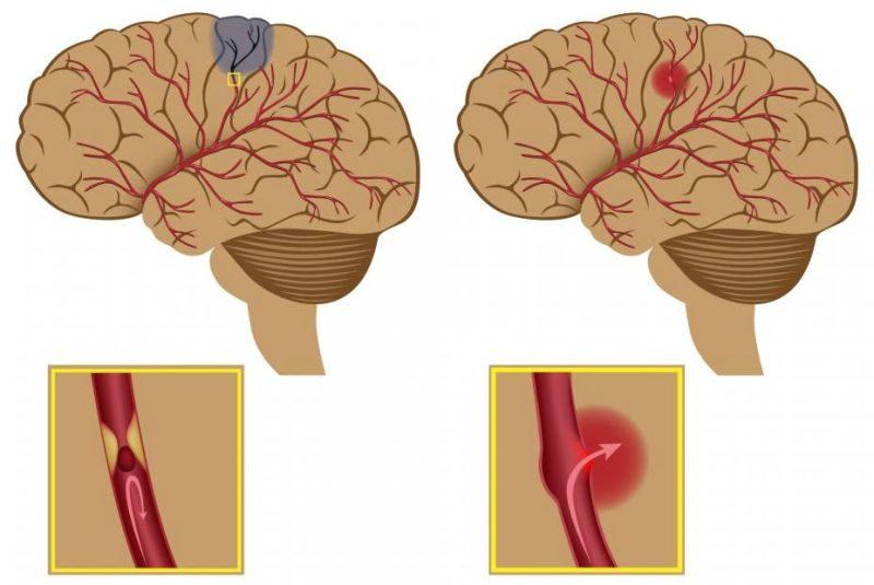 Геморрагическая форма инсульта