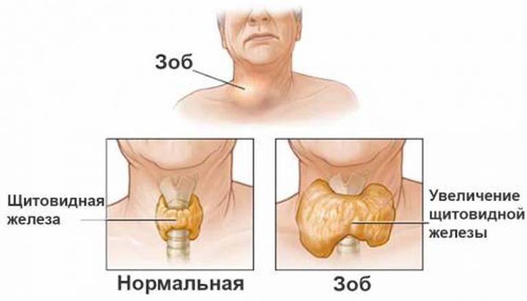 Тиреотоксикоз