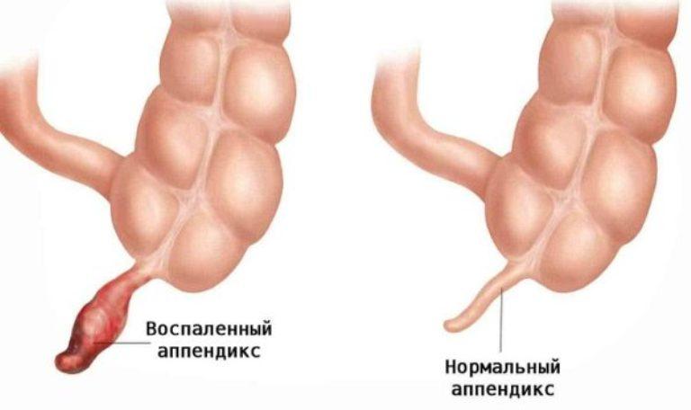 Воспаленный и нормальный аппендикс