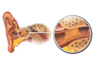 место скопления ушной серы