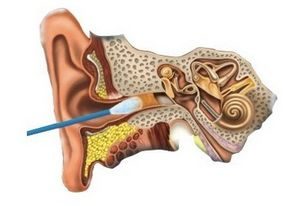 причины образования пробки в ухе