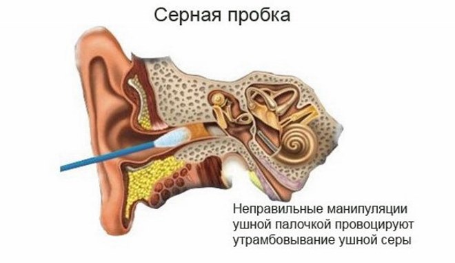 утромбование серы ушной палочкой