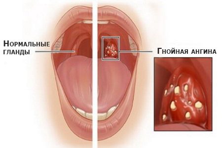 образование гноя в горле