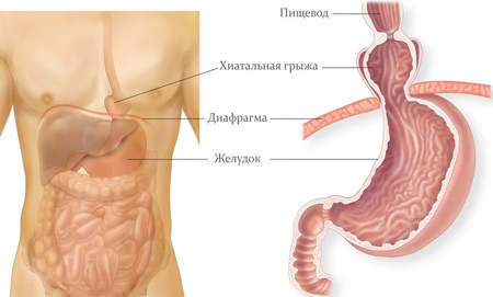 Хиатальная грыжа