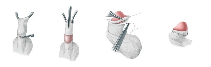 операция по лечению фимоза
