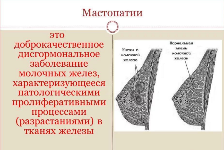 Мастопатия