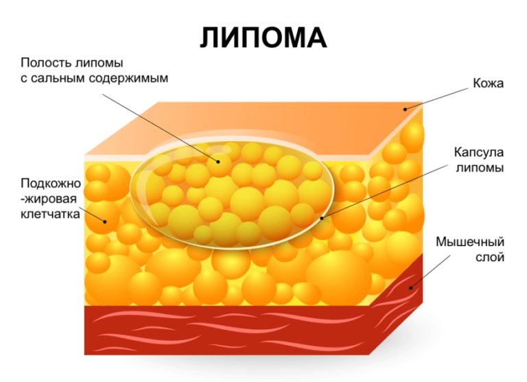 Липома молочной железы