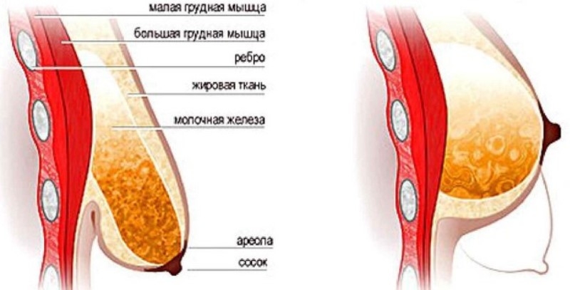 Подтяжка грудных желез без имплантов