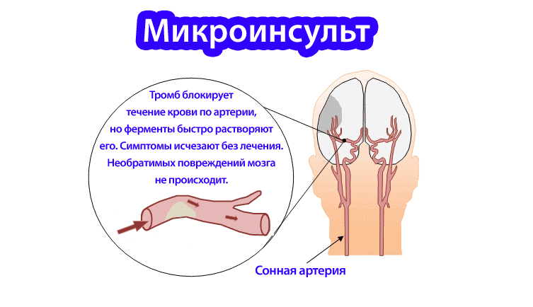 Микроинсульт схема