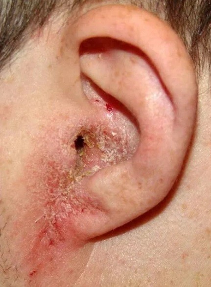 Заболевание кожи на ухе