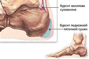 Бурсит ахиллова сухожилия