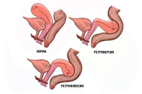 Загиб матки – симптомы и лечение, фото и видео. 