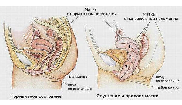 Загиб матки – симптомы и лечение, фото и видео. 