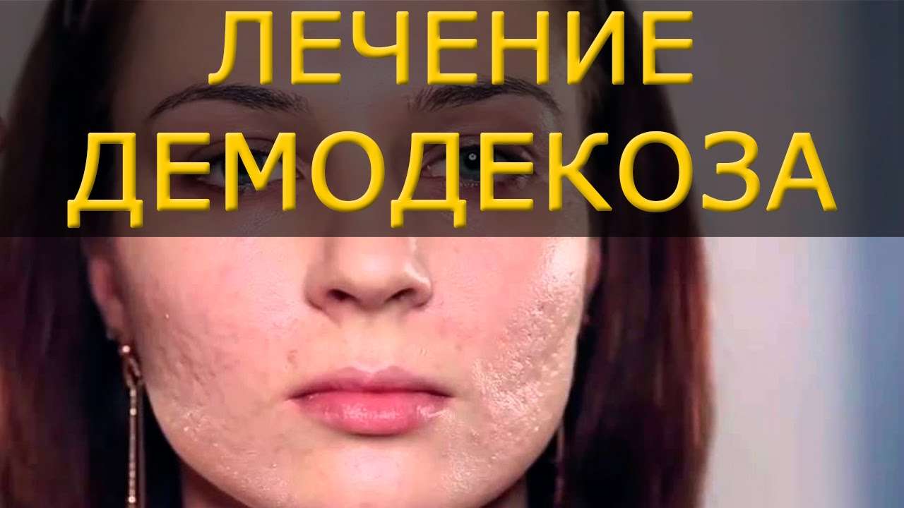 лечение демодекоза