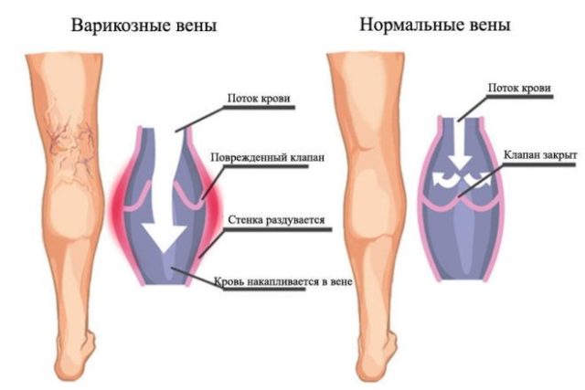 Деформация вен при варикозе